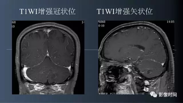 【病例】脑内环形强化3例影像诊断与分析