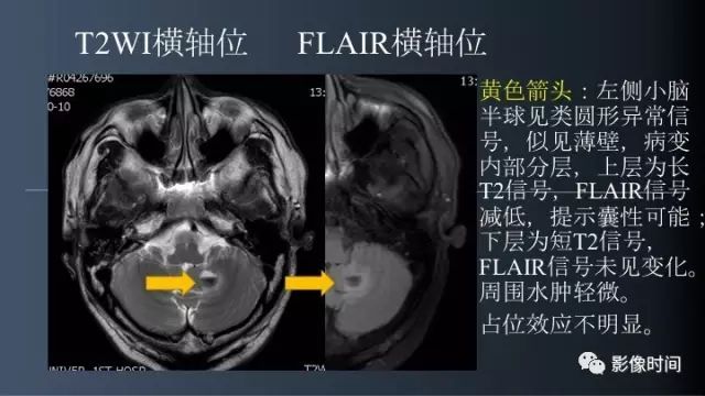 【病例】脑内环形强化3例影像诊断与分析