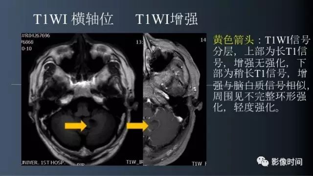 【病例】脑内环形强化3例影像诊断与分析