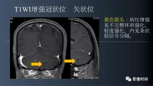 【病例】脑内环形强化3例影像诊断与分析
