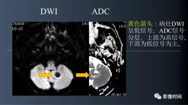 【病例】脑内环形强化3例影像诊断与分析