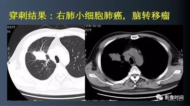 【病例】脑内环形强化3例影像诊断与分析