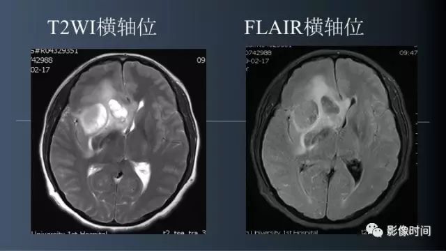 【病例】脑内环形强化3例影像诊断与分析