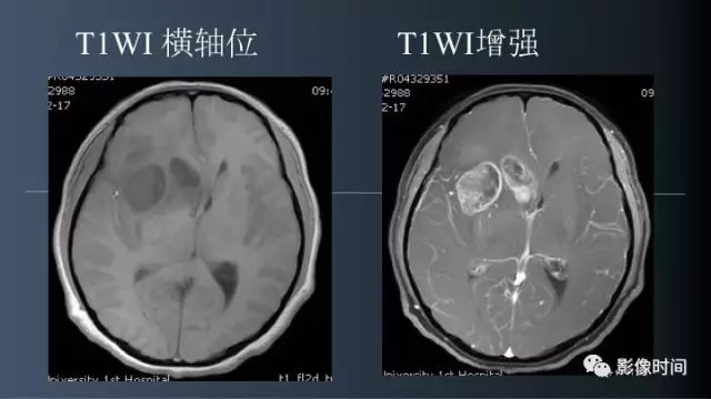 【病例】脑内环形强化3例影像诊断与分析