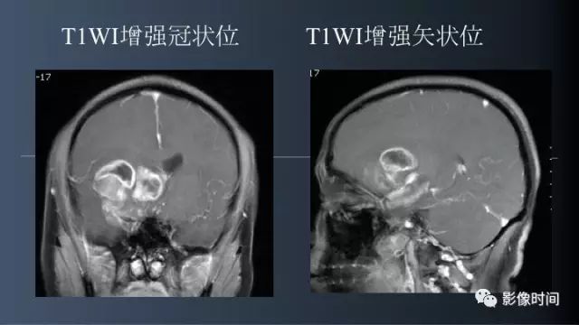 【病例】脑内环形强化3例影像诊断与分析