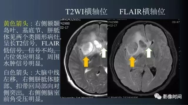 【病例】脑内环形强化3例影像诊断与分析