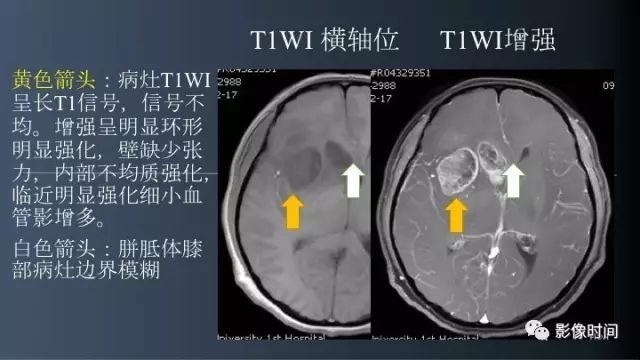 【病例】脑内环形强化3例影像诊断与分析
