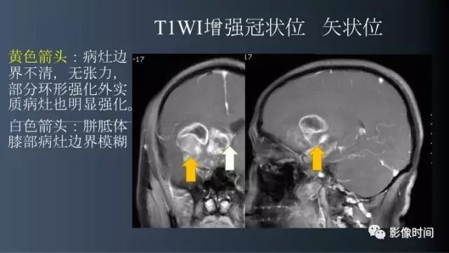 【病例】脑内环形强化3例影像诊断与分析