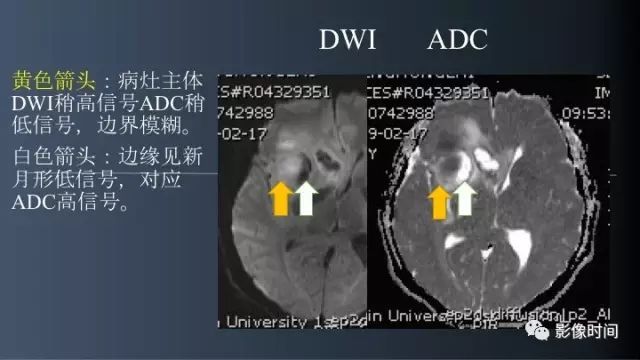 【病例】脑内环形强化3例影像诊断与分析
