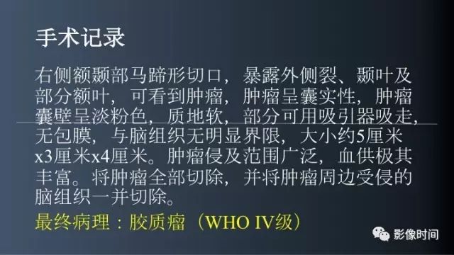【病例】脑内环形强化3例影像诊断与分析