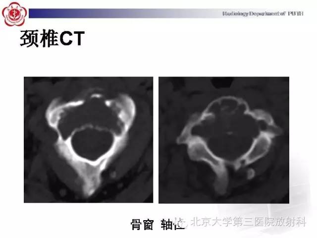 【病例】C2椎体血管瘤1例CT及MR影像表现