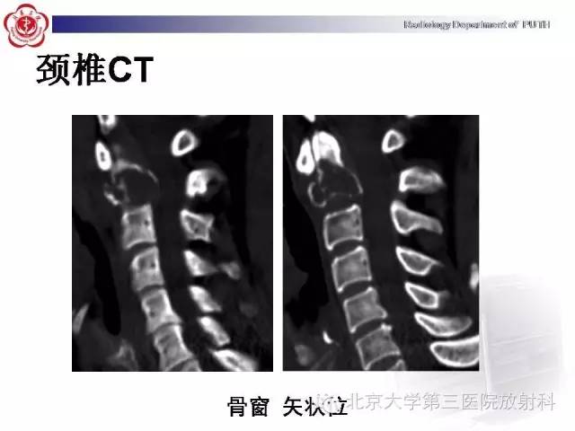 【病例】C2椎体血管瘤1例CT及MR影像表现