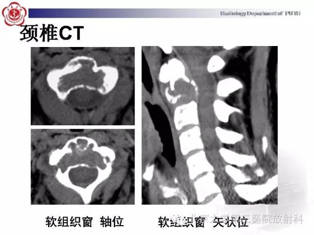 【病例】C2椎体血管瘤1例CT及MR影像表现