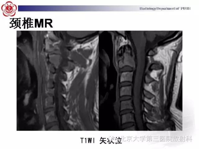 【病例】C2椎体血管瘤1例CT及MR影像表现