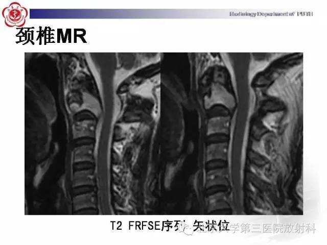 【病例】C2椎体血管瘤1例CT及MR影像表现