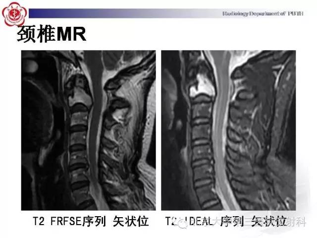 【病例】C2椎体血管瘤1例CT及MR影像表现