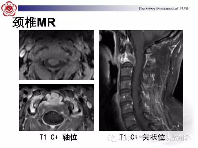 【病例】C2椎体血管瘤1例CT及MR影像表现