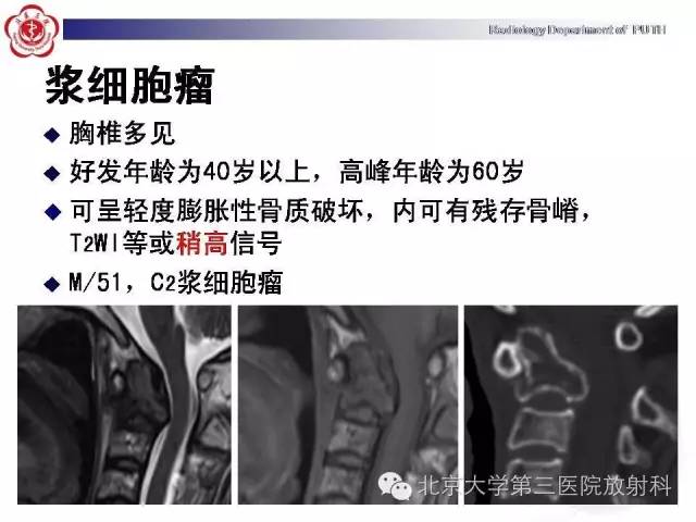 【病例】C2椎体血管瘤1例CT及MR影像表现