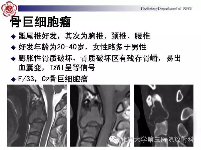 【病例】C2椎体血管瘤1例CT及MR影像表现