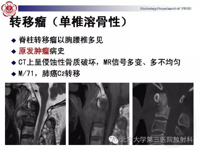 【病例】C2椎体血管瘤1例CT及MR影像表现