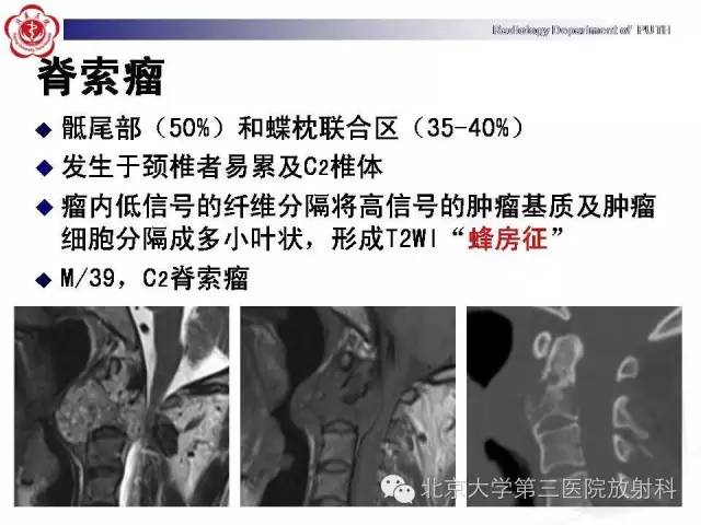 【病例】C2椎体血管瘤1例CT及MR影像表现