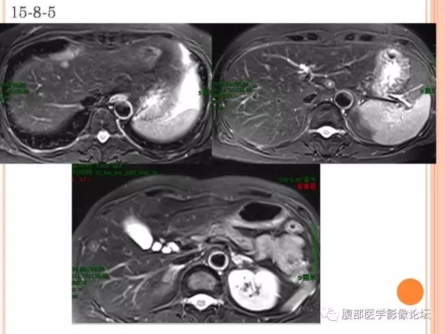【病例】肝脏孤立性坏死结节SNN一例MR 【病例】肝脏孤立性坏死结节SNN一例MR
