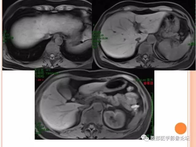 【病例】肝脏孤立性坏死结节SNN一例MR 【病例】肝脏孤立性坏死结节SNN一例MR