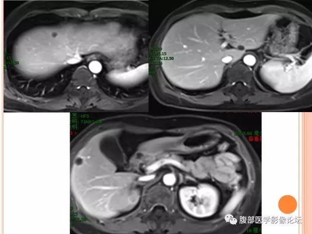 【病例】肝脏孤立性坏死结节SNN一例MR 【病例】肝脏孤立性坏死结节SNN一例MR