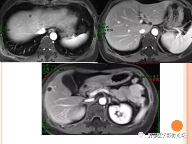 【病例】肝脏孤立性坏死结节SNN一例MR 【病例】肝脏孤立性坏死结节SNN一例MR