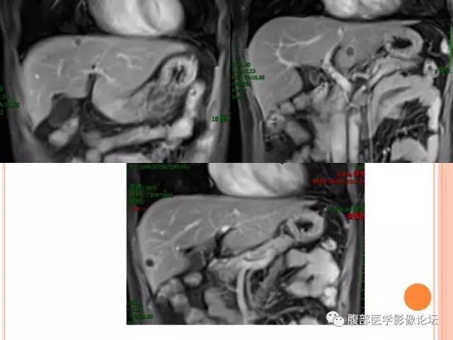 【病例】肝脏孤立性坏死结节SNN一例MR 【病例】肝脏孤立性坏死结节SNN一例MR