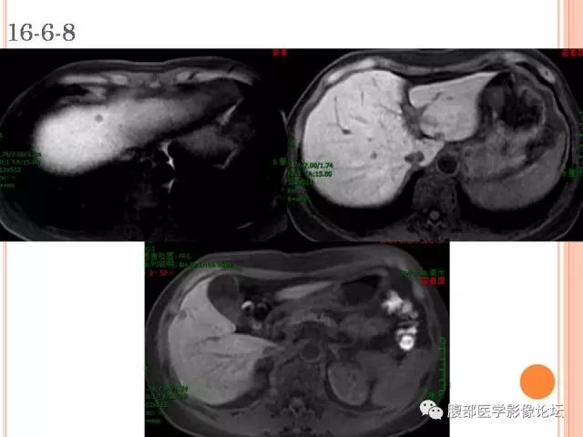 【病例】肝脏孤立性坏死结节SNN一例MR 【病例】肝脏孤立性坏死结节SNN一例MR
