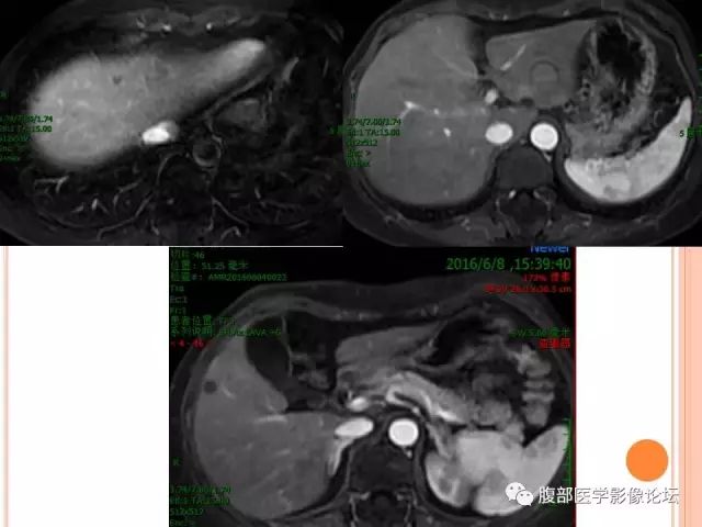 【病例】肝脏孤立性坏死结节SNN一例MR 【病例】肝脏孤立性坏死结节SNN一例MR