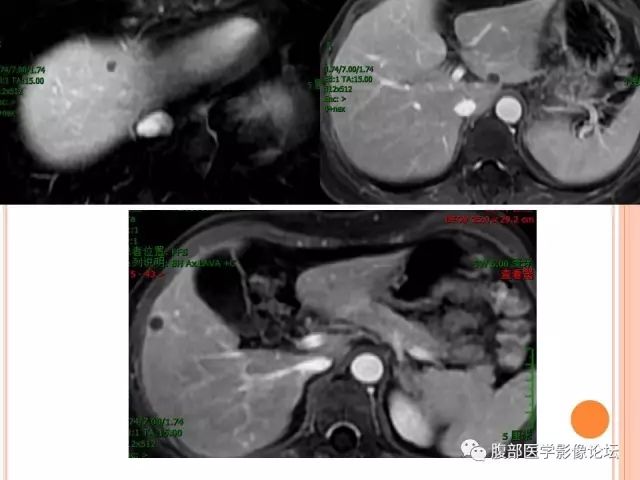 【病例】肝脏孤立性坏死结节SNN一例MR 【病例】肝脏孤立性坏死结节SNN一例MR