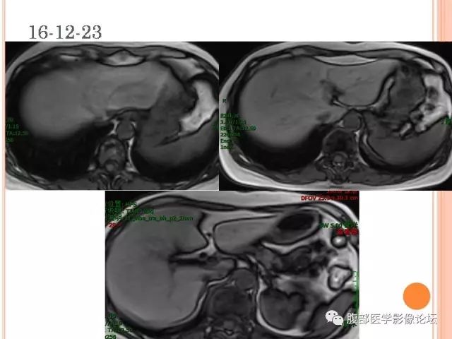 【病例】肝脏孤立性坏死结节SNN一例MR 【病例】肝脏孤立性坏死结节SNN一例MR