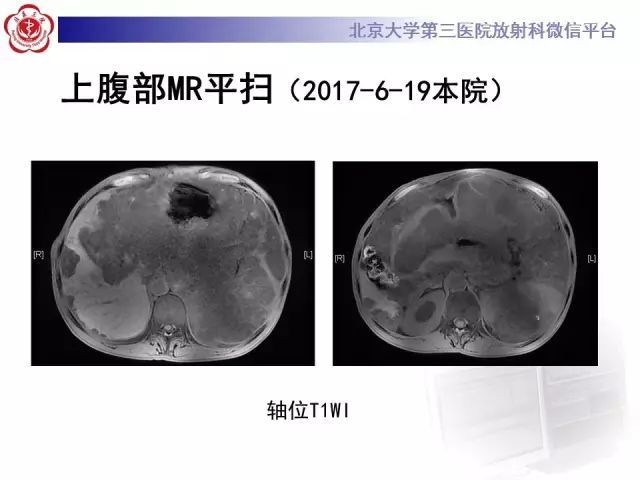 【病例】腹膜假性粘液瘤1例CT影像诊断