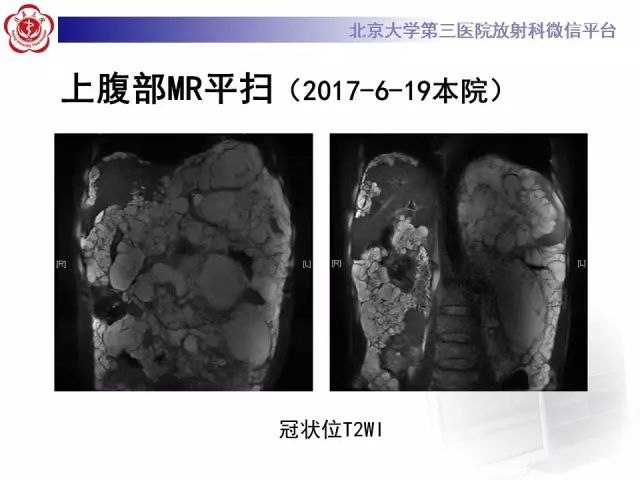 【病例】腹膜假性粘液瘤1例CT影像诊断