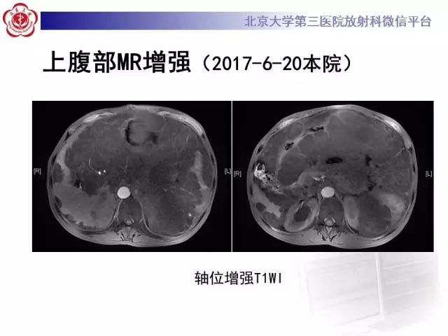 【病例】腹膜假性粘液瘤1例CT影像诊断