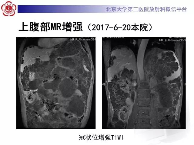 【病例】腹膜假性粘液瘤1例CT影像诊断