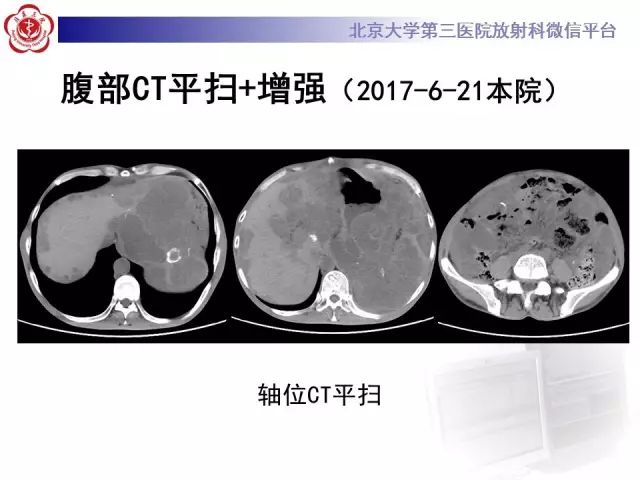 【病例】腹膜假性粘液瘤1例CT影像诊断