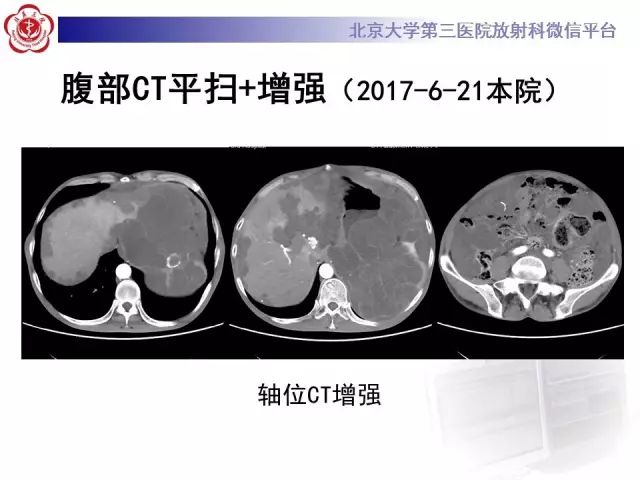 【病例】腹膜假性粘液瘤1例CT影像诊断