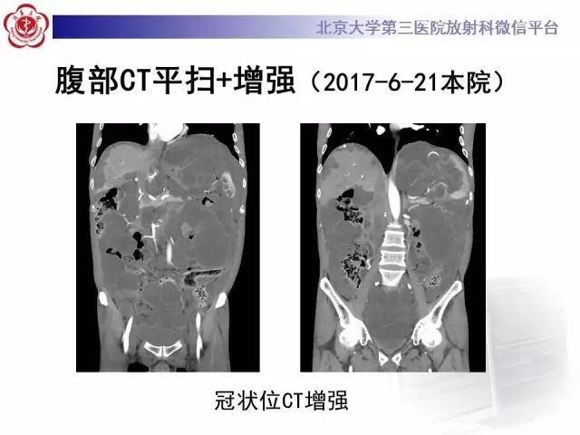 【病例】腹膜假性粘液瘤1例CT影像诊断