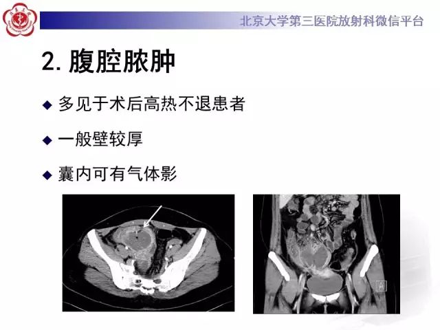 【病例】腹膜假性粘液瘤1例CT影像诊断