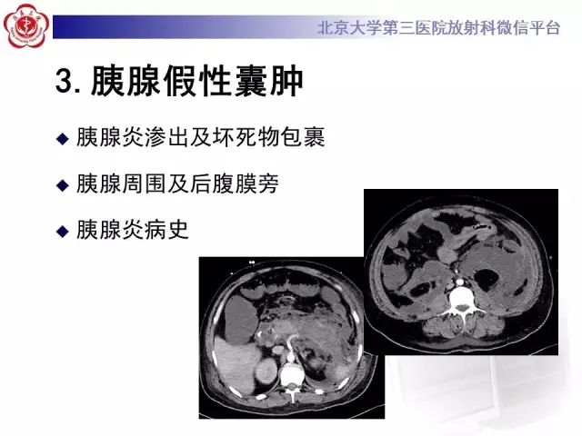 【病例】腹膜假性粘液瘤1例CT影像诊断