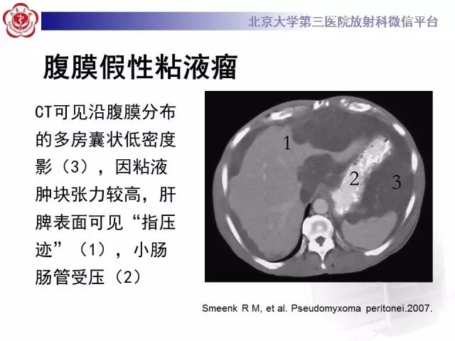 【病例】腹膜假性粘液瘤1例CT影像诊断