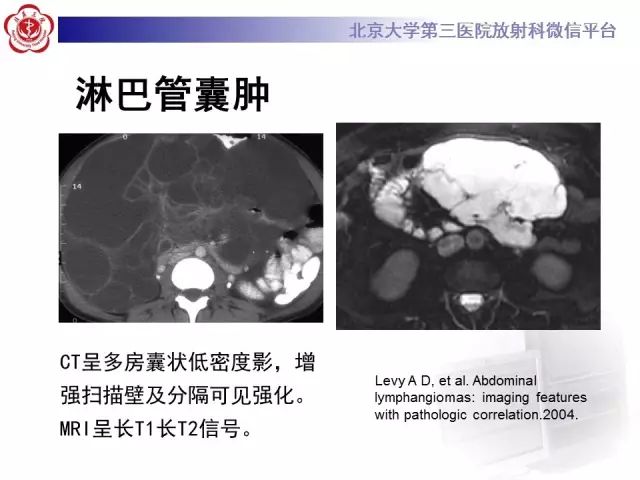 【病例】腹膜假性粘液瘤1例CT影像诊断