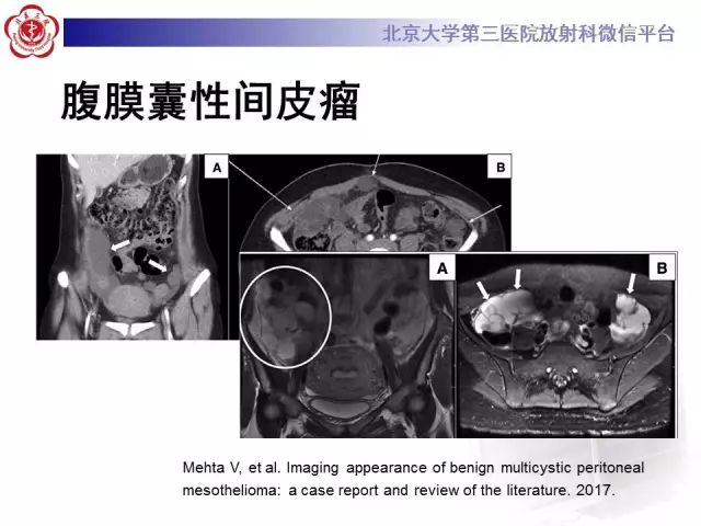 【病例】腹膜假性粘液瘤1例CT影像诊断
