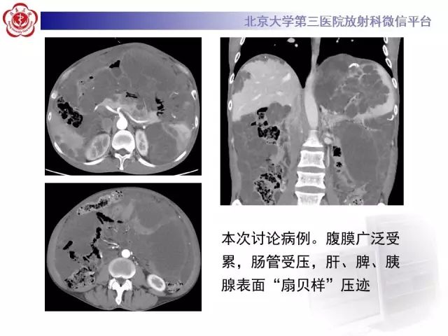 【病例】腹膜假性粘液瘤1例CT影像诊断