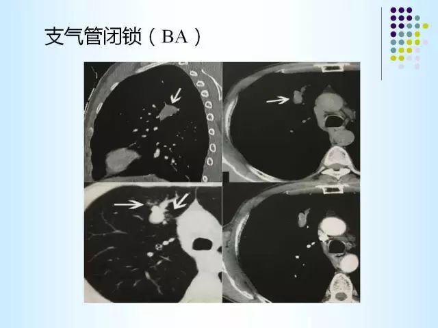 【PPT】肺多发囊状病变的CT诊断