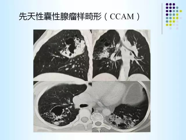 【PPT】肺多发囊状病变的CT诊断