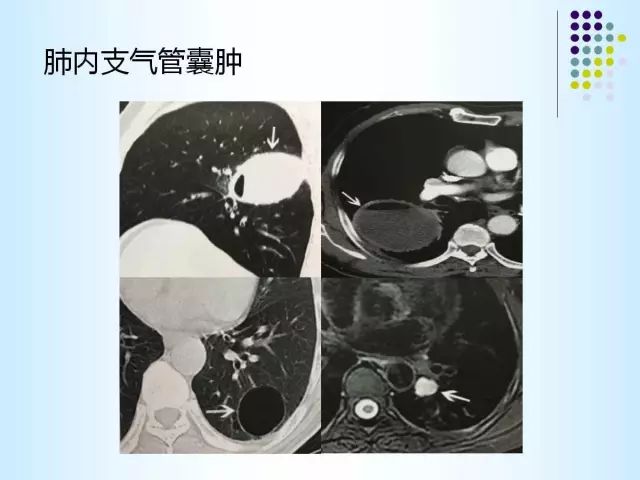 【PPT】肺多发囊状病变的CT诊断